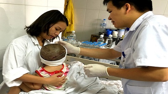 Ca ghép da đầu cho cháu bé nhỏ tuổi nhất ở Việt Nam